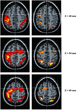 A comparison of the frontal and parietal activation in music performance (left) and music imagery (right) A comparison of the frontal and parietal activation in music performance (left) and music imagery (right)